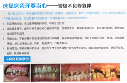 选择烤瓷牙要当心